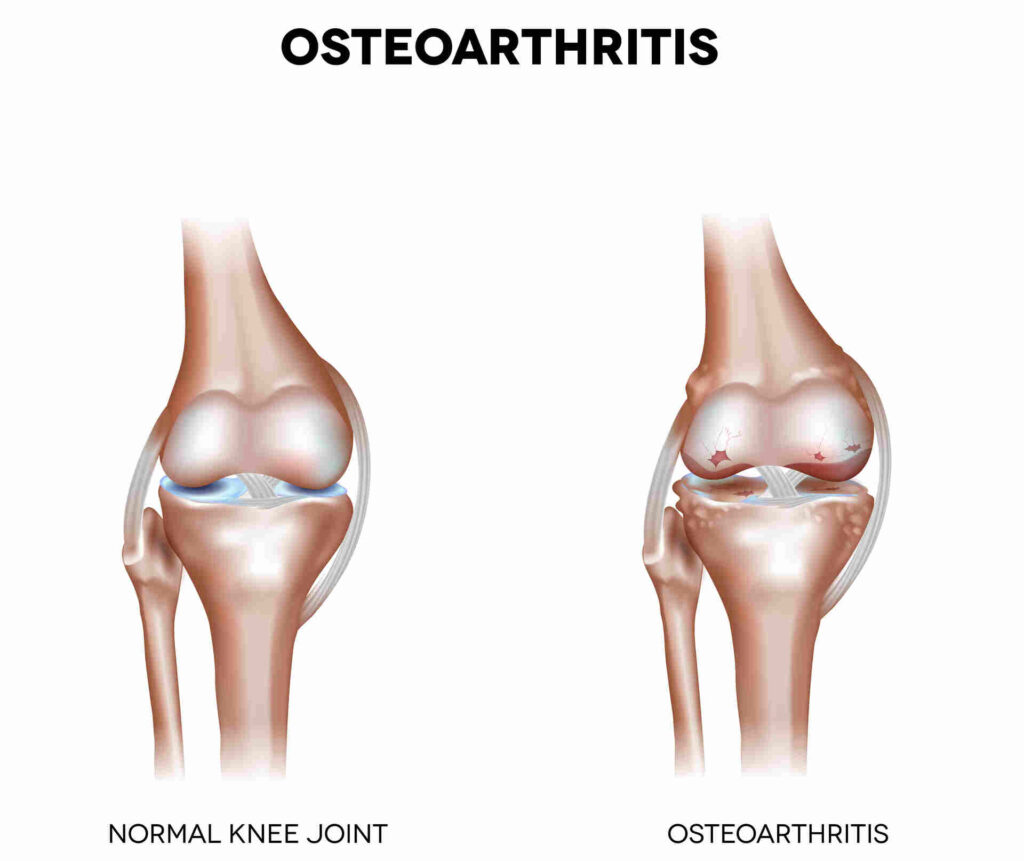 normal knee joint vs osteoarthritis