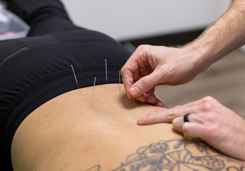 person getting dry needling