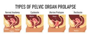 types-of-pelvic-organ-prolapse